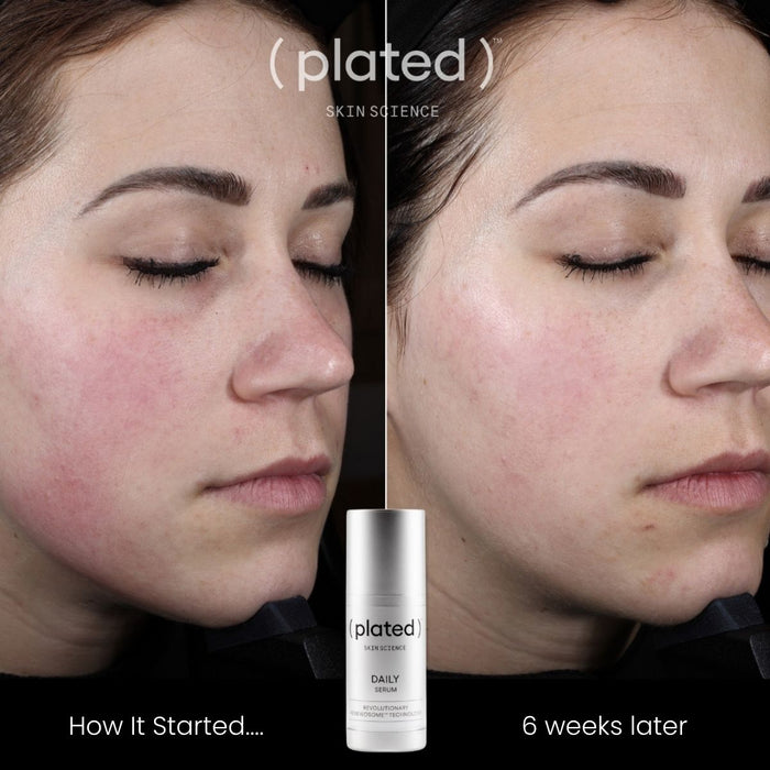 Before-and-after comparison of a woman's face after using ( plated ) Skin Science DAILY Serum for 6 weeks