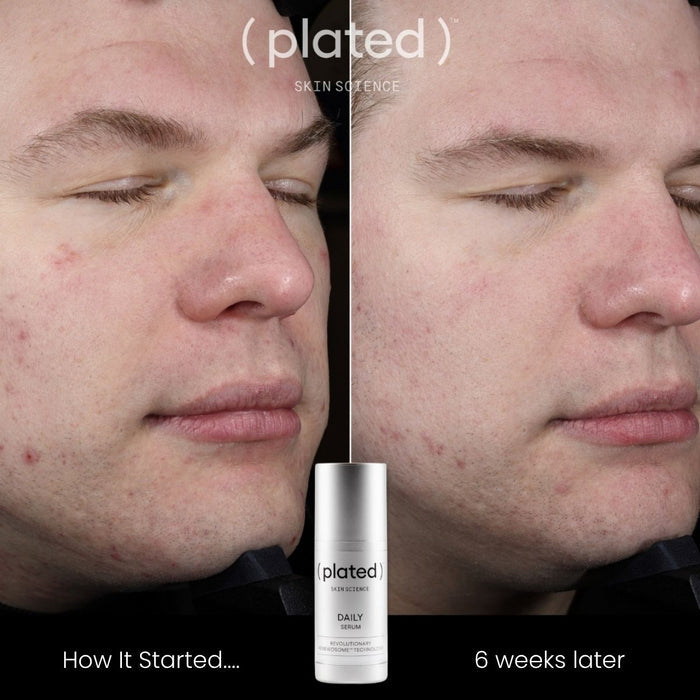 Comparison of a man's face before and after 6 weeks of using the ( plated ) Skin Science DAILY Serum.
