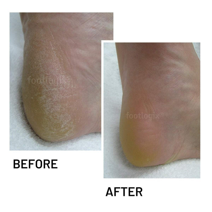 Footlogix Cracked Heel Formula, 4.2 oz
