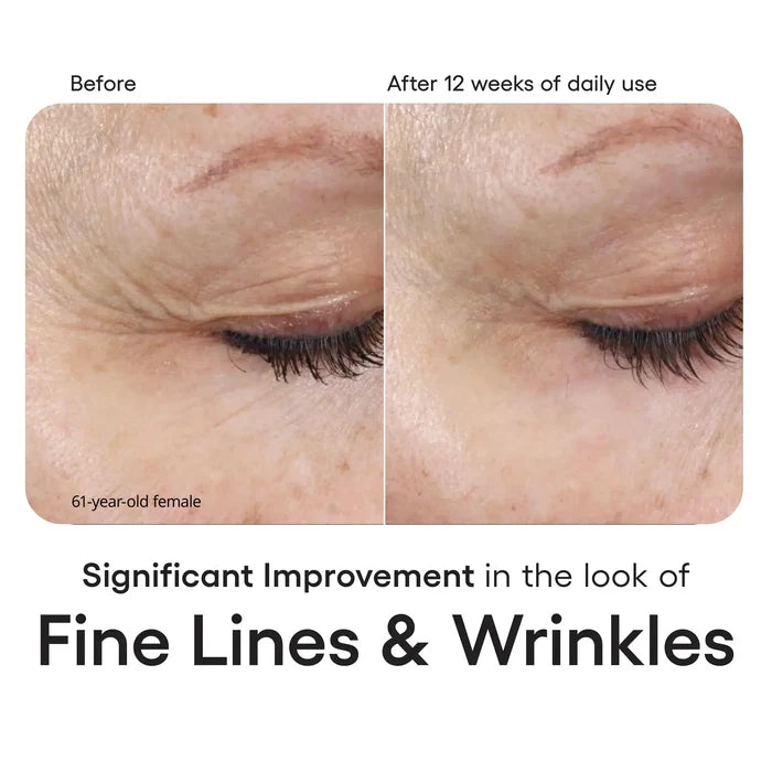Before-and-after comparison of the eye area of a 61-year-old female, which states significant improvement in the look of fine lines and wrinkles